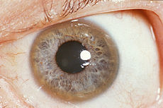 230px-Kayser-Fleischer_ring